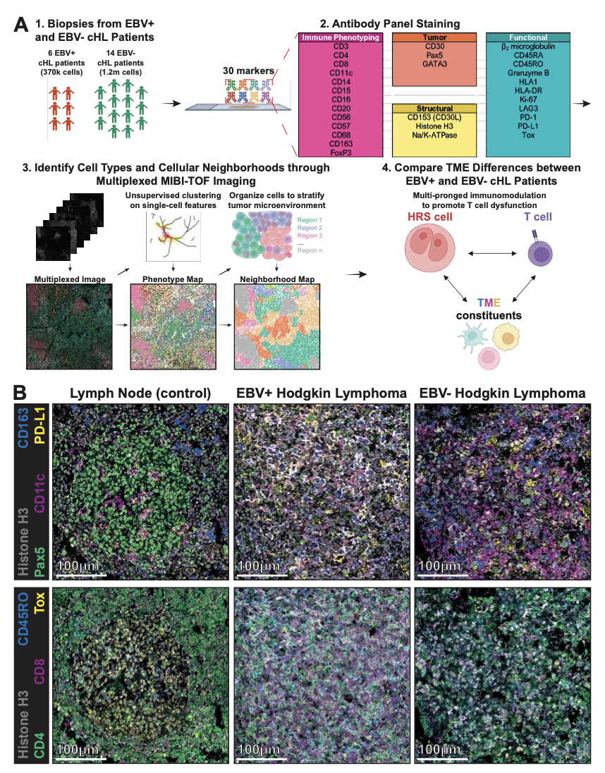Epstein-Barr Virus Orchestrates Spatial Reorganization and Immunomodulation within the Classic Hodgkin Lymphoma Tumor Microenvironment